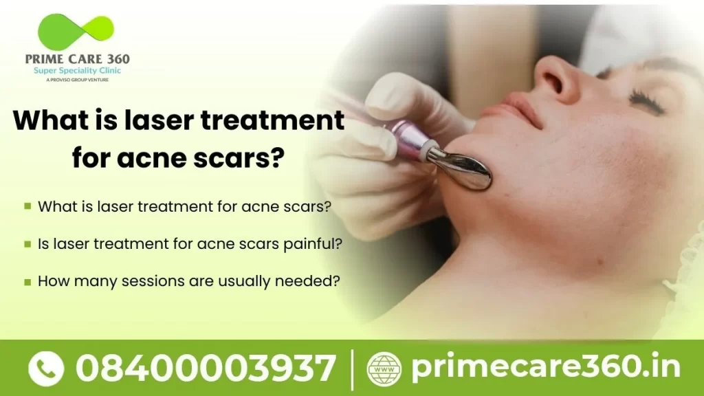 Laser Treatment for Acne Scars Cost
